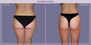 Before and after pictures of Liposculpture treatment